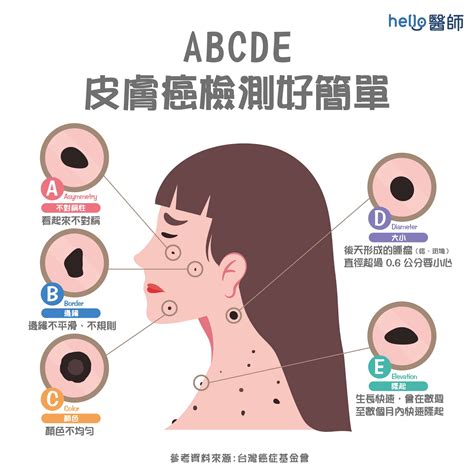 屁股長黑痣|痣形成的原因？痣長毛、痣變多變大是痣病變？5招判。